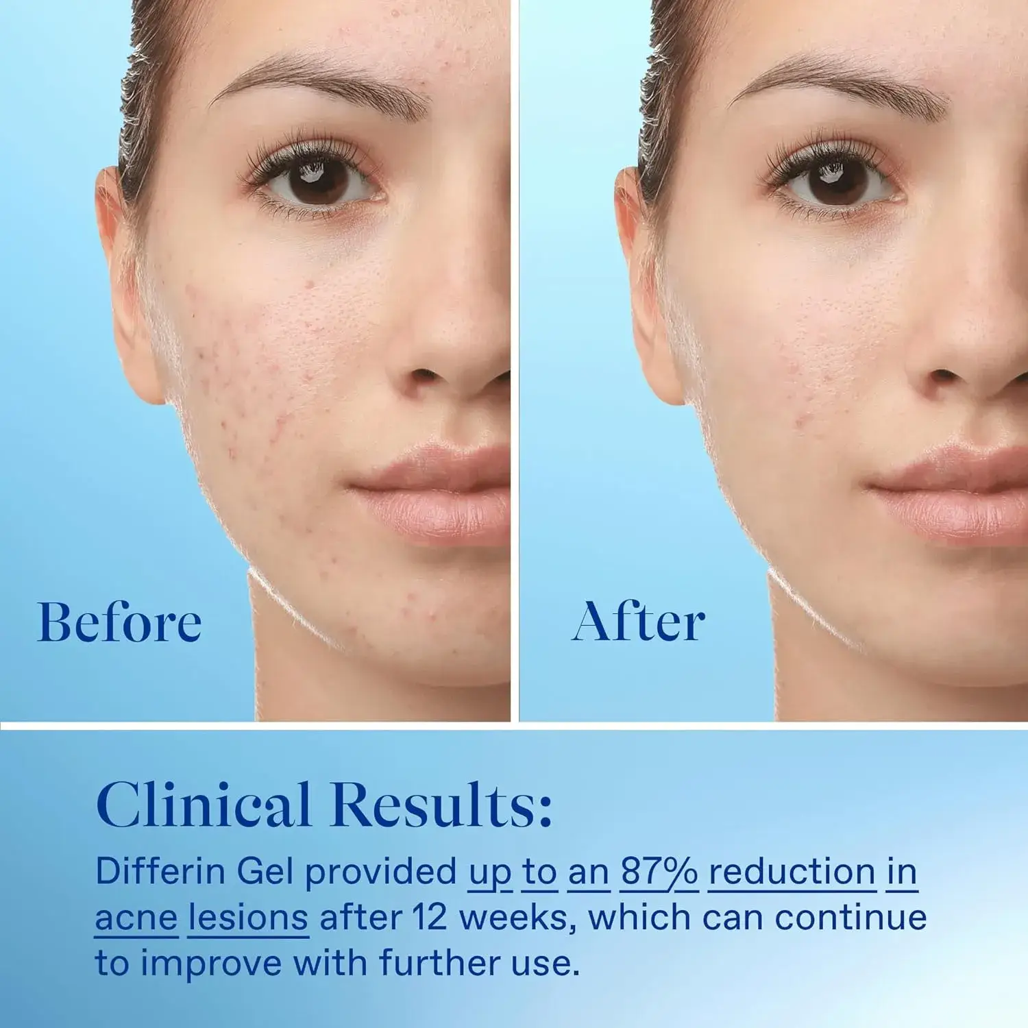Differin Adapalene 0.1% Acne Treatment Gel 15G product image